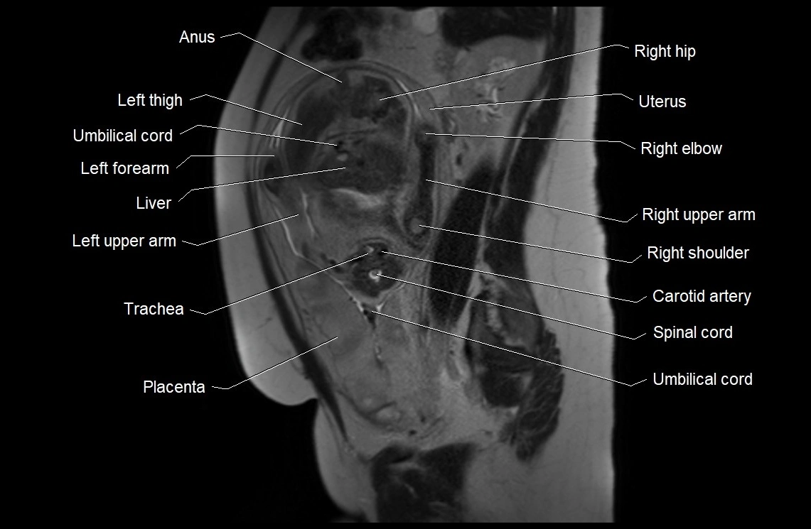 MRI fetal anatomy sagittal image 13.webp
